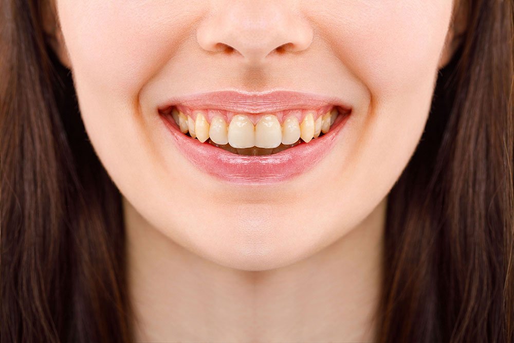 teeth whitening 6 Before image