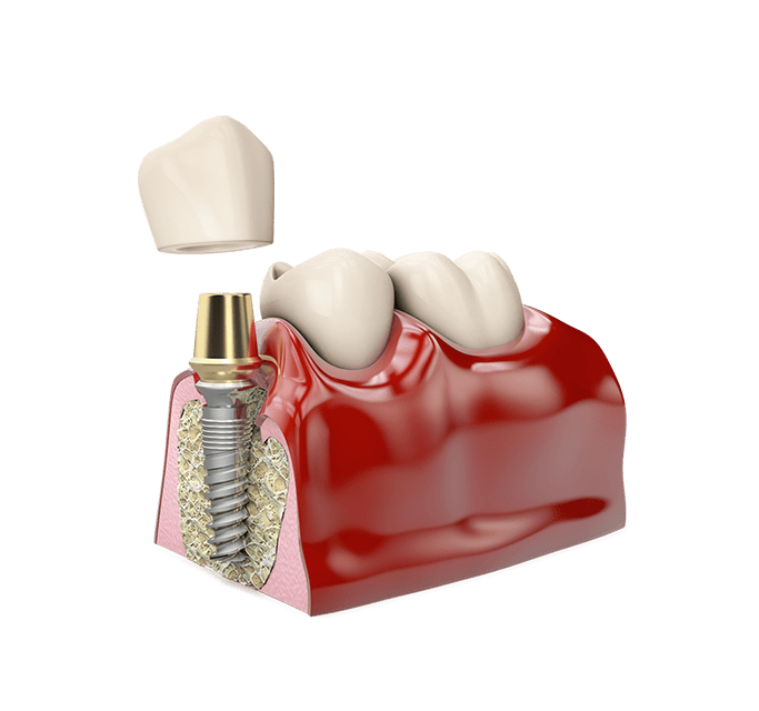 Dental implant 6 Dental implant 6