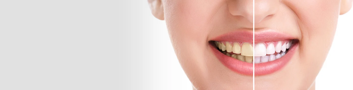 teeth whitening 2